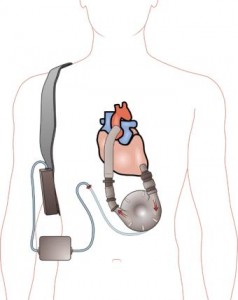 340px-Ventricular_assist_device